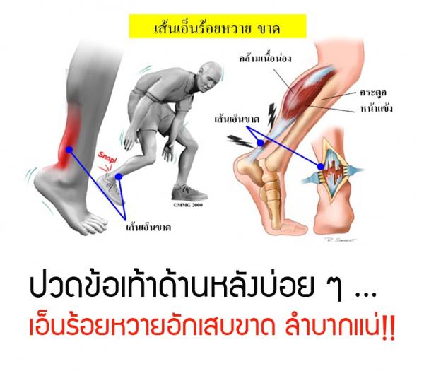 ปวดเท้าด้านหลังบ่อย ๆ เอ็นร้อยหวายอักเสบ